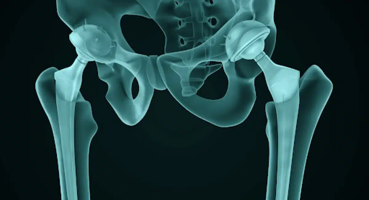 Ortopedia – Rápida recuperação pós artroplastia de quadril e joelho